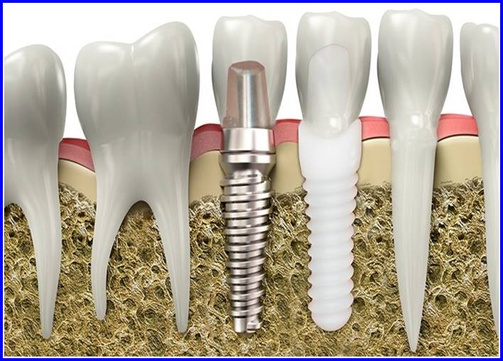 Choosing Excellence: Why Ceramic Implants Are the Ideal Dental Solution